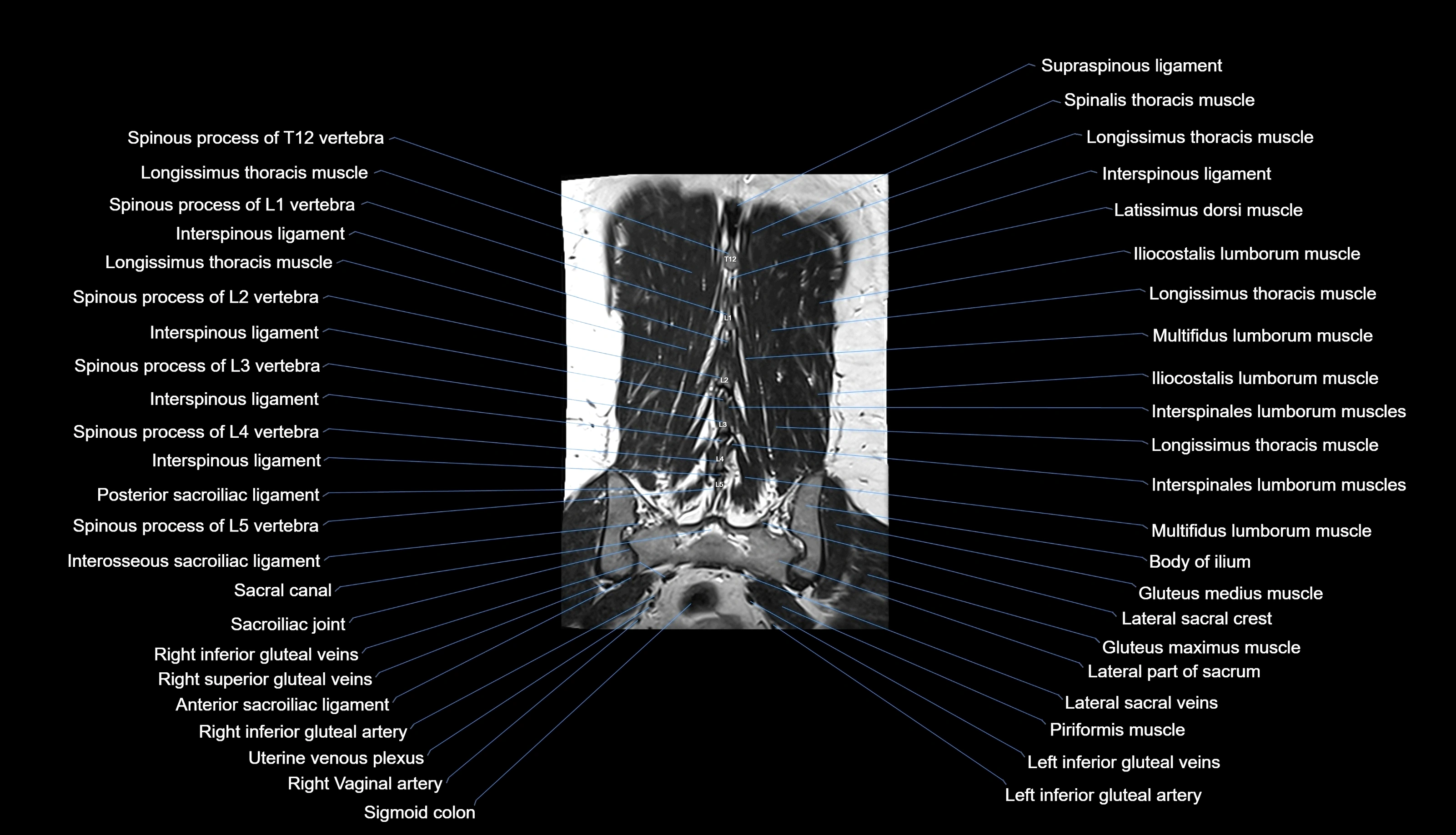 MRI lumbar spine labelled coronal cross sectional anatomy 3T radiology-img-00001-00031.webp